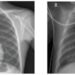 Machine learning, quantum computing may transform health care, including diagnosing pneumonia