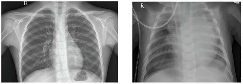 Machine learning, quantum computing may transform health care, including diagnosing pneumonia